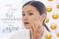 How To Feel Confident With Acne?